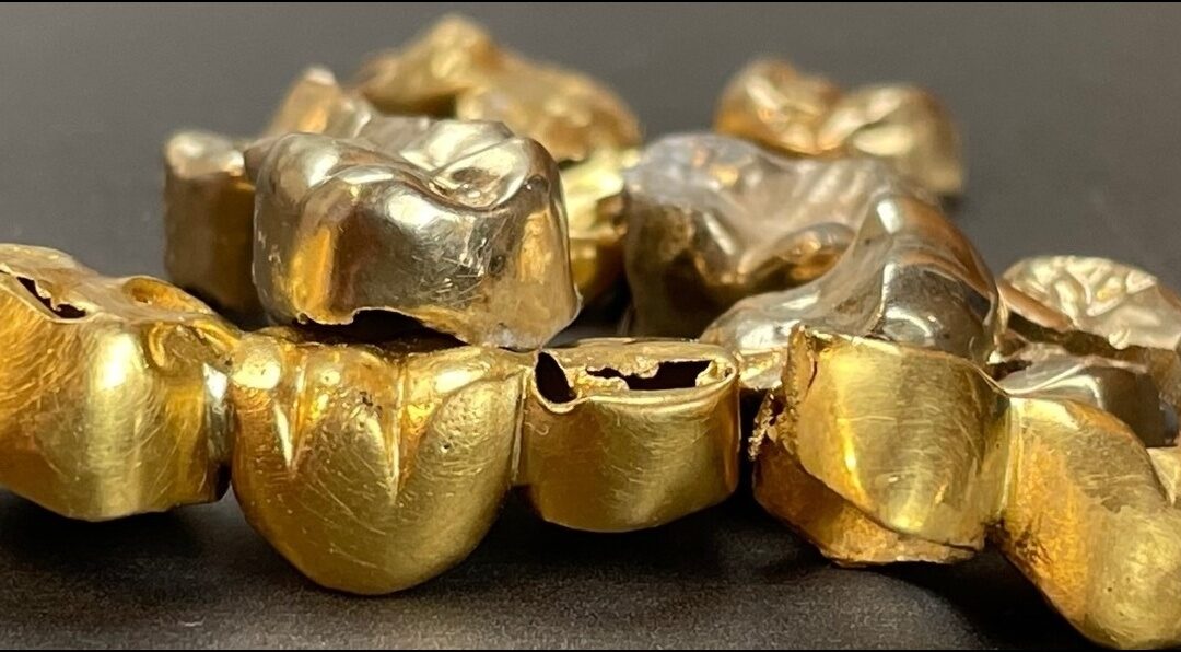 Zahn-Gold – Zahnersatz, vergessen, verdrängt oder einfach übersehen