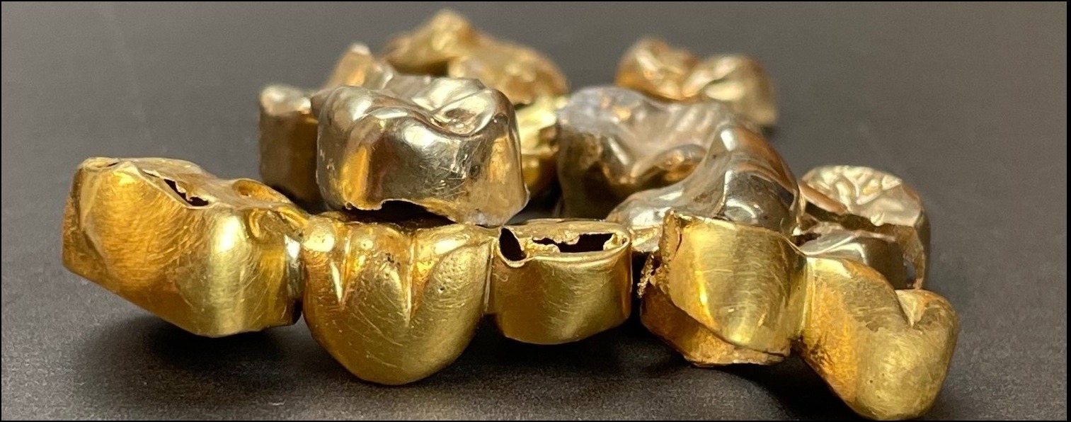 Zahngold – vergessen, verdrängt oder einfach übersehen